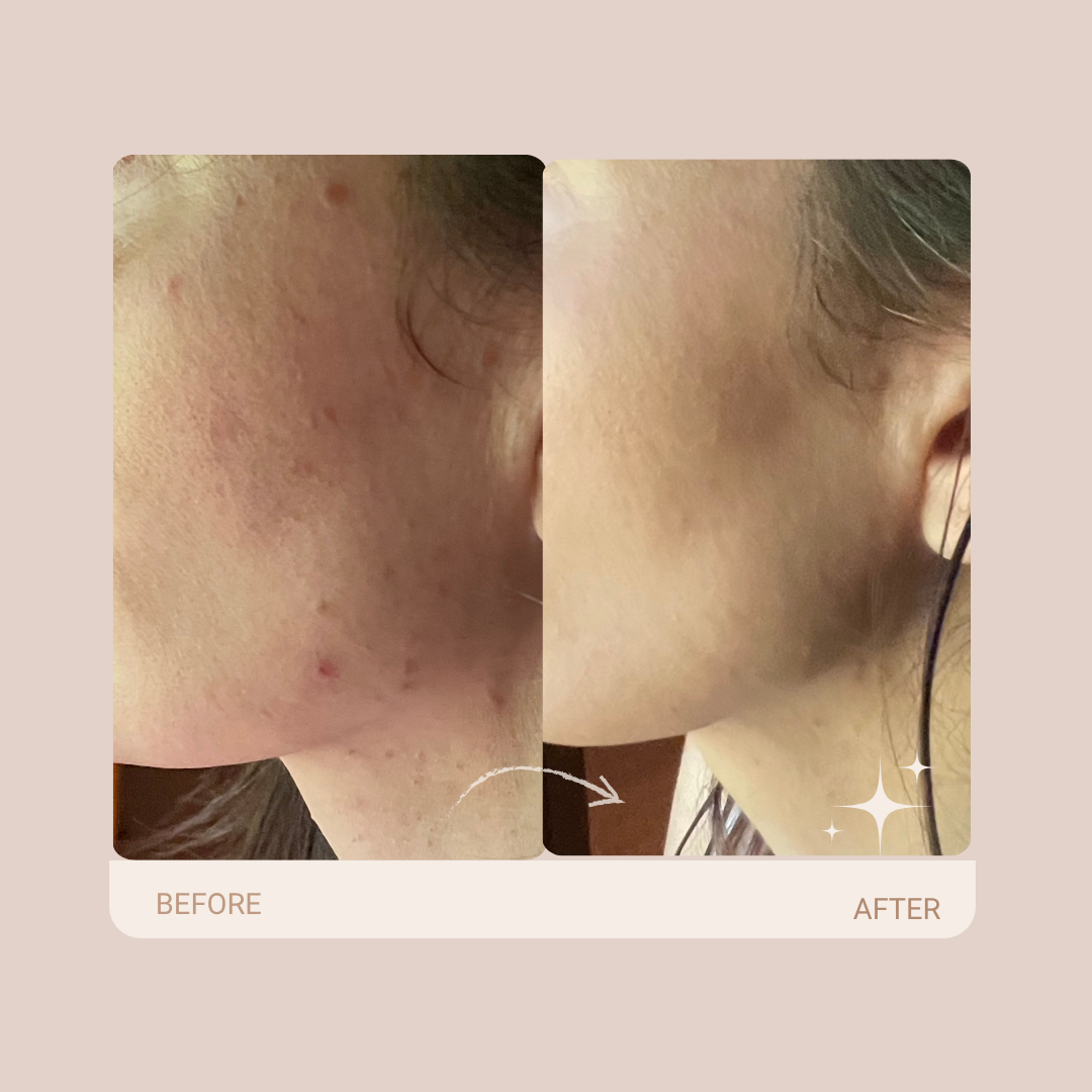 Broke Out Again? Why HOCl Should Be Your First Line of Defense