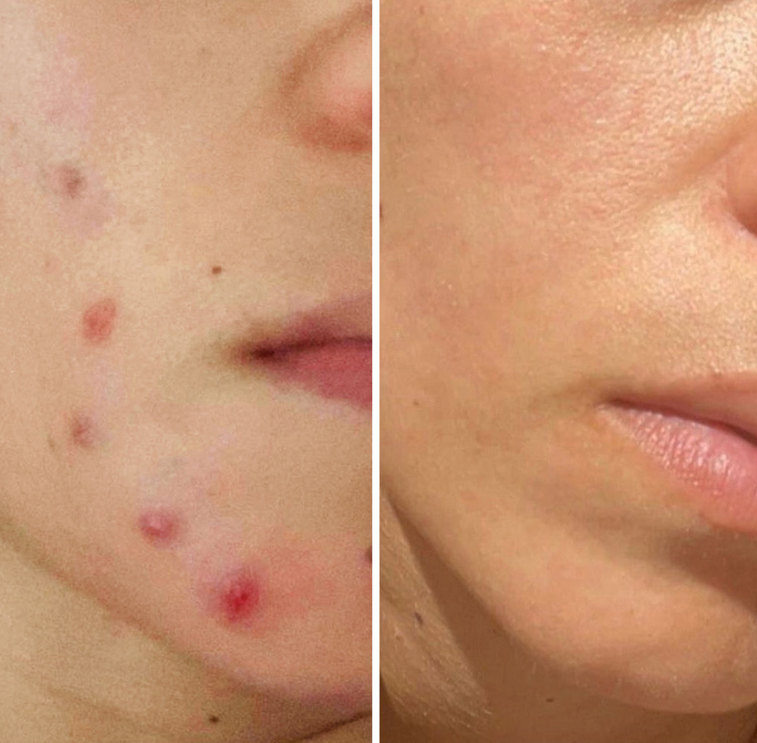 Before and after image a women's face - first image she is broken out and the second image is clear skin after using LUMION skin.