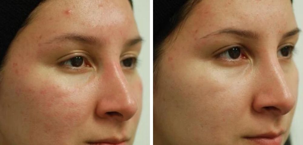 HOCL: 2020's Best Skincare and Acne Solution