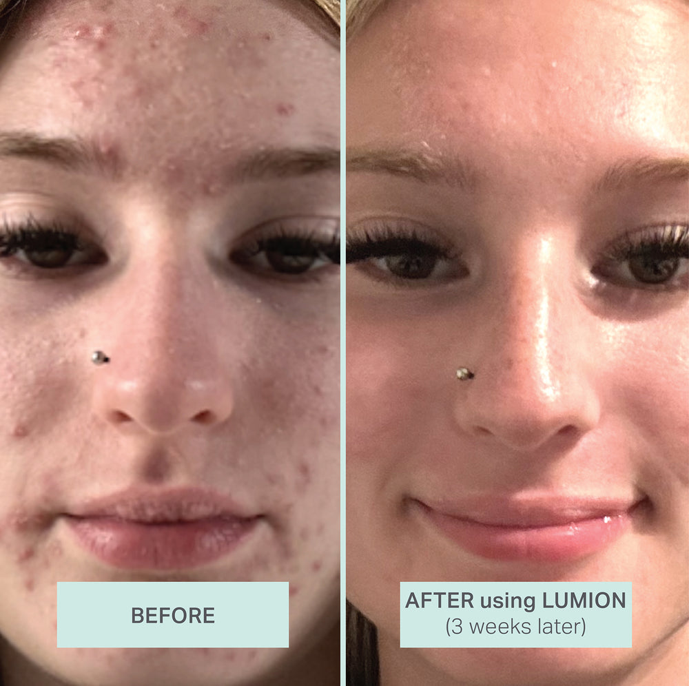 Before and after photo of a women who used LUMION Spray and LUMION Mist to help visibly clear her skin. 